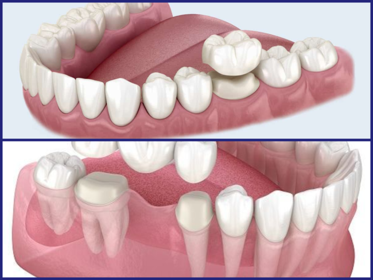 Zahnkrone Kosten: Was Sie wirklich wissen sollten, bevor Sie sich entscheiden Zahnkrone Kosten